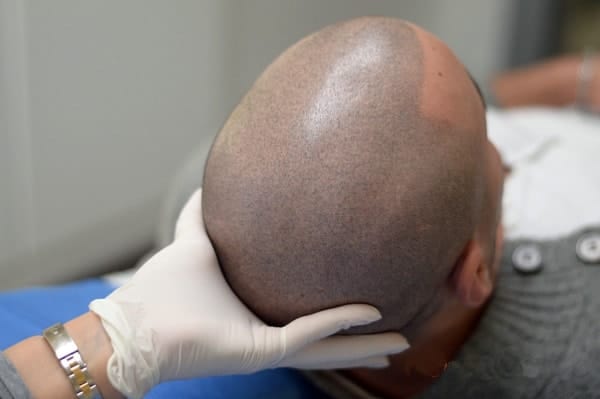 risultato micropigmentazione
