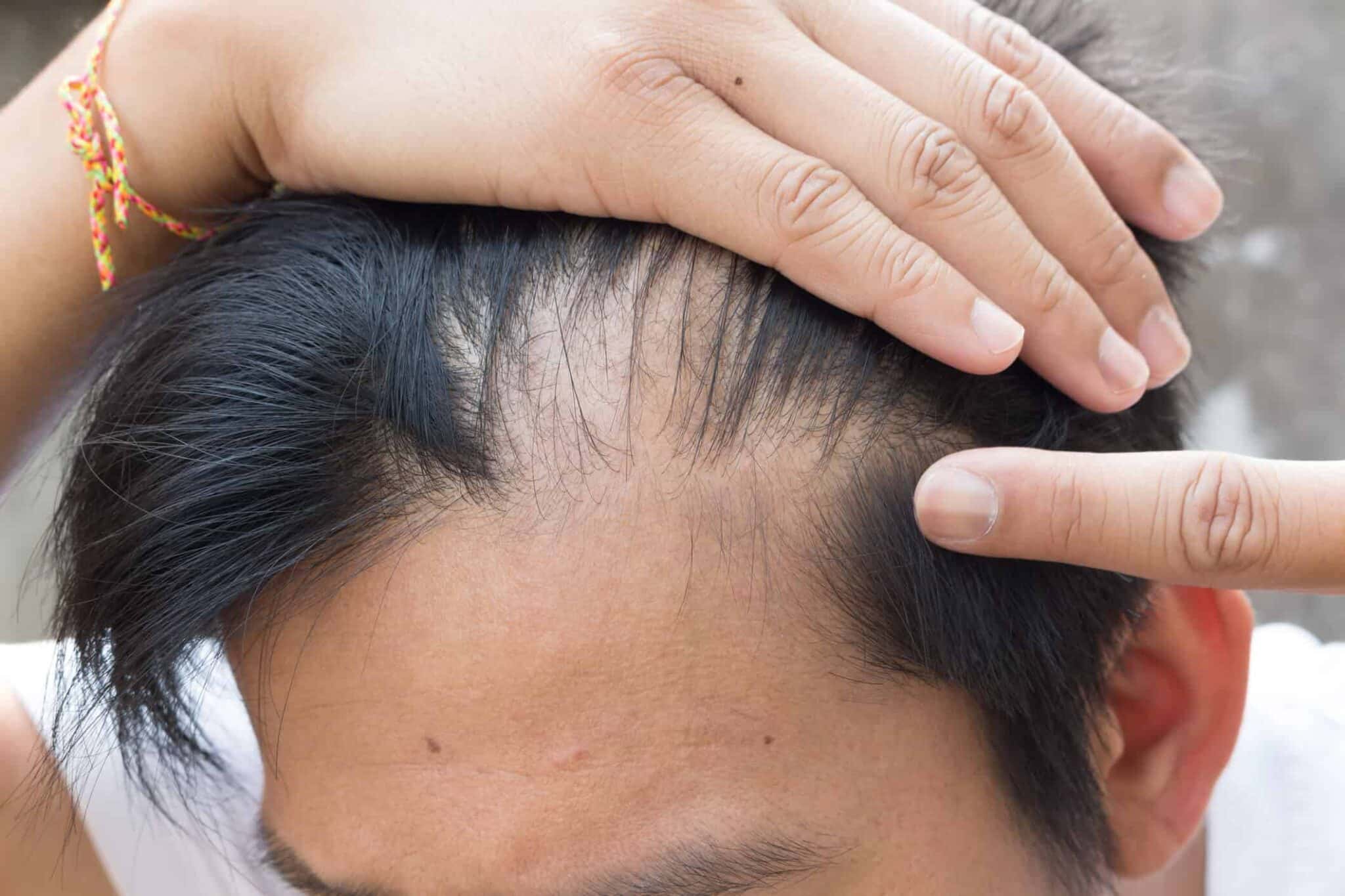 alopecia uomo alopecia uomo