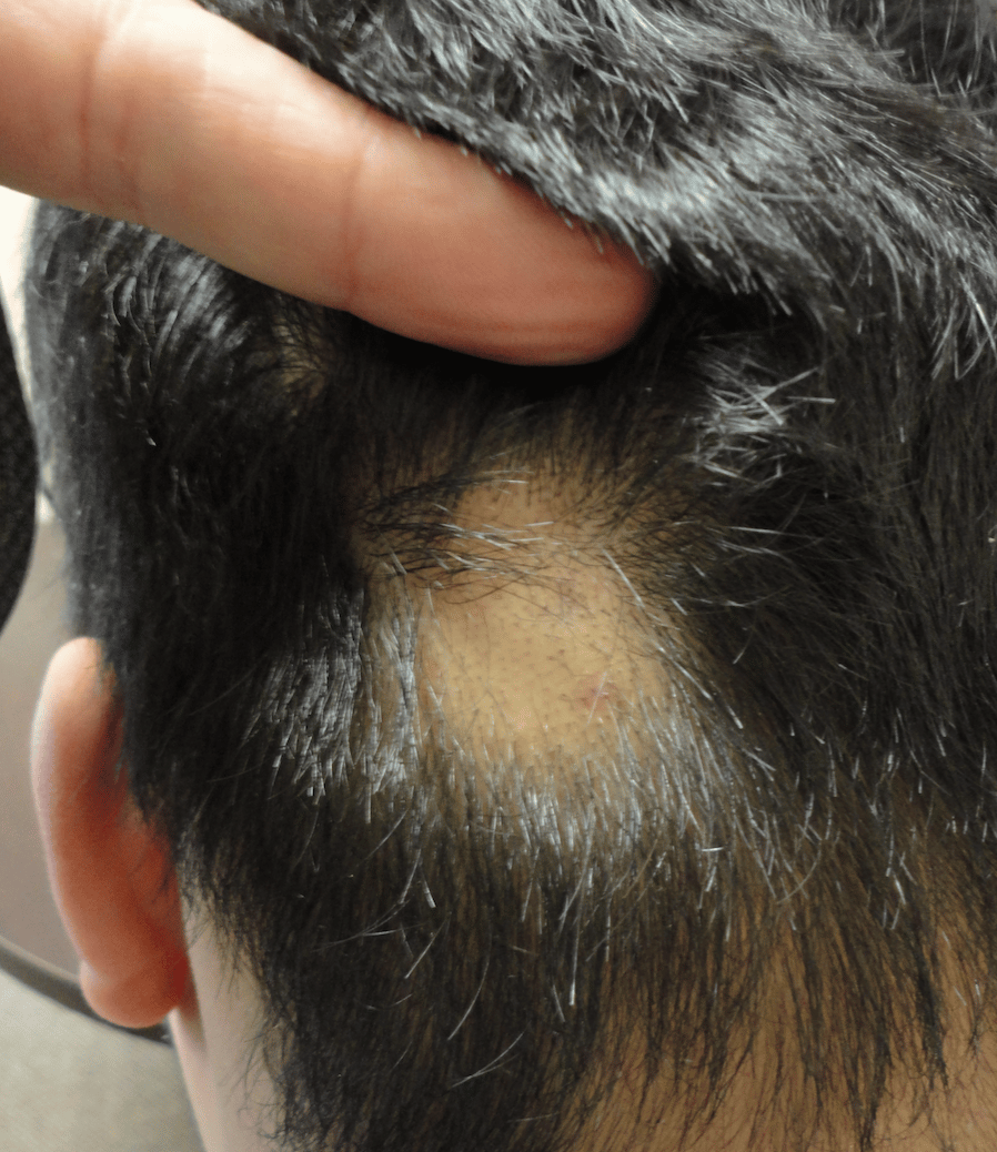 alopecia alopecia