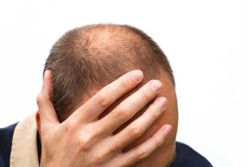 caduta capelli