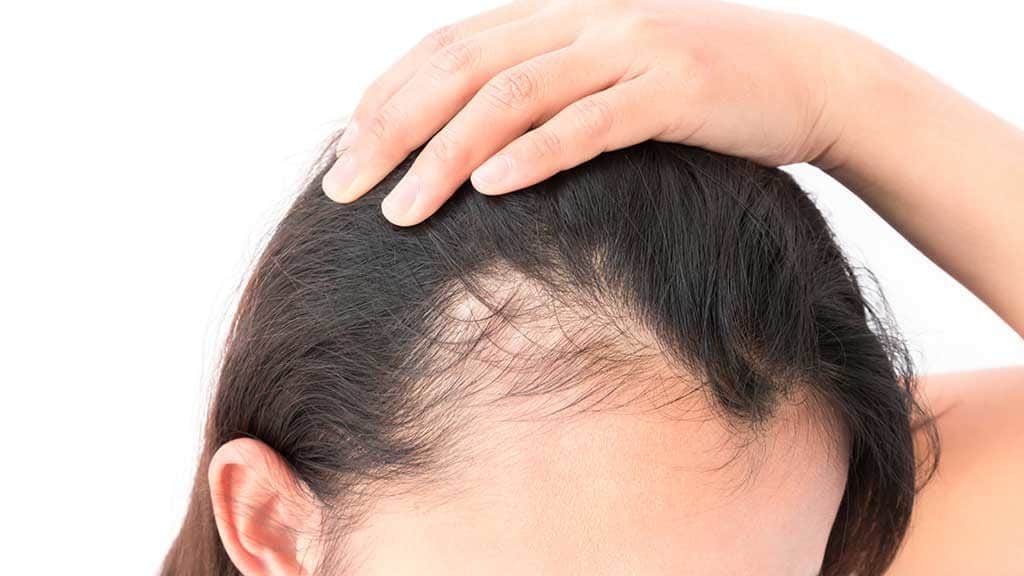caduta dei capelli donne