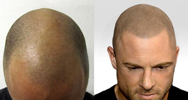 tatuaggio capelli