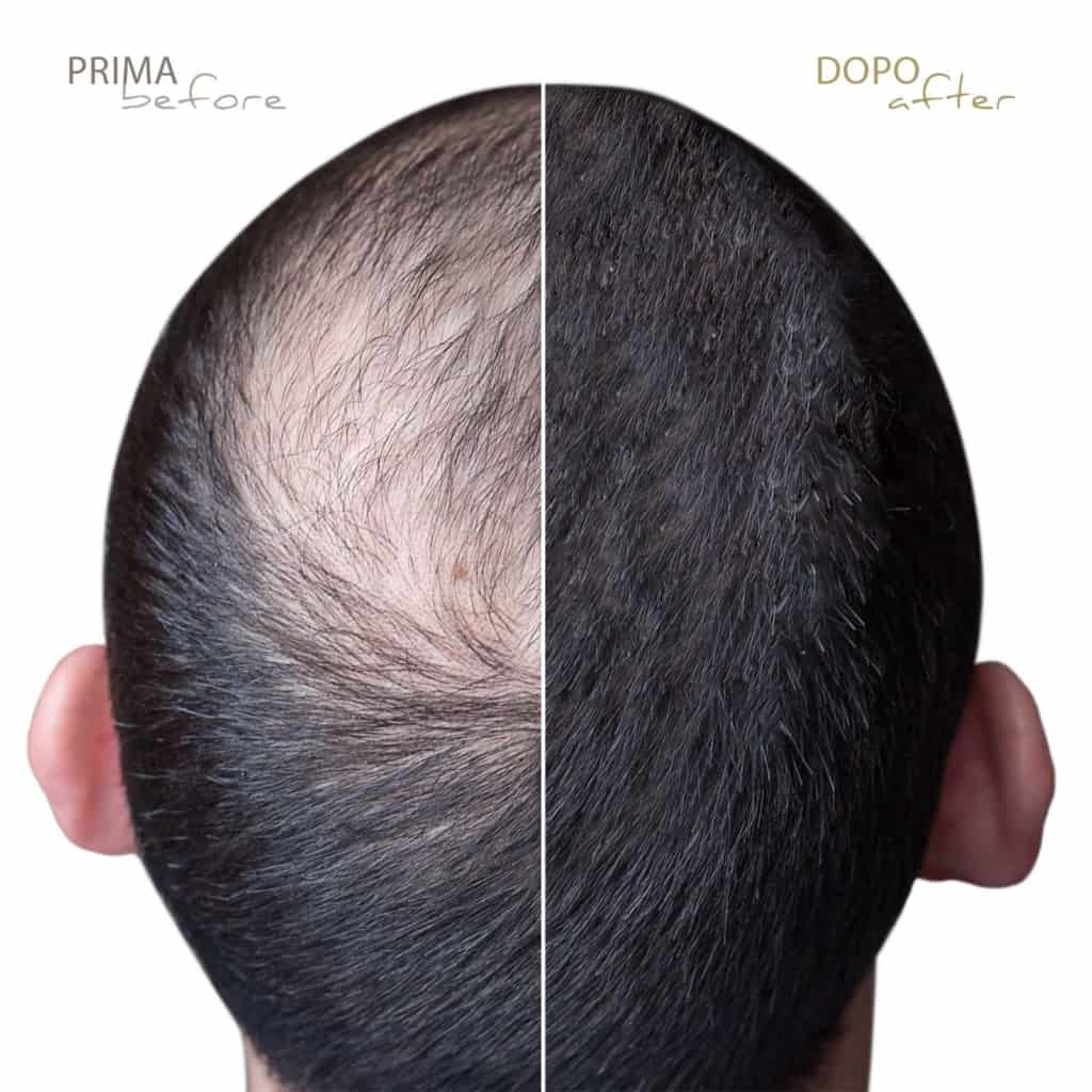 trico-pigmentazione